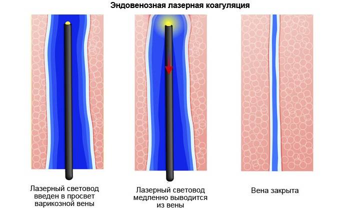 Варикоз Вен Заднего Прохода